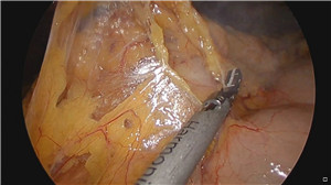 腹腔镜胰十二指肠切除术