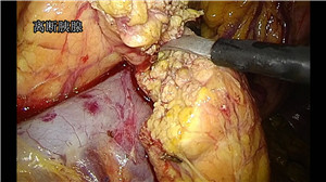 全腹腔镜胰十二指肠切除术（胰肠吻合）　<sup><span style=color:#ff0000;><strong>二等奖</strong></span></sup>