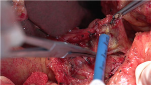 胰十二指肠切除术