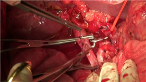 胰头癌新辅助化疗降期后胰十二指肠切除+门静脉切除重建