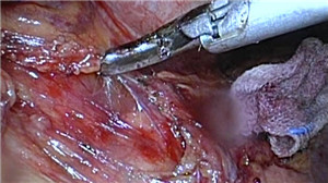 全腹腔镜远端胃D2手术