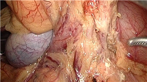 腹腔镜辅助远端胃切除术+D2淋巴结清扫
