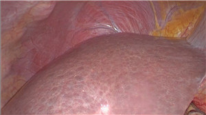 腹腔镜右半肝切除术