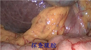 腹腔镜前入路右半肝