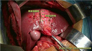 二步法肝切除术