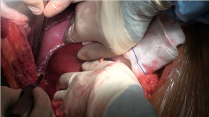 规则性S7、S8段肝切除术