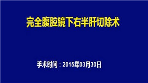腹腔镜下右半肝切除术