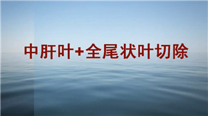 中肝叶+全尾状叶切除
