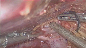 腹腔镜右半肝切除术