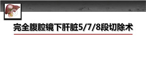 完全腹腔镜下肝脏5、7、8段切除术　<sup><span style=color:#ff0000;><strong>三等奖</strong></span></sup>