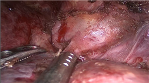 腹腔镜背侧入路解剖性左半肝切除术