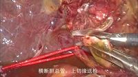 腹腔镜胆总管癌根治性切除术
