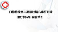 门静脉栓塞二期腹腔镜右半肝切除治疗复杂肝胆管结石