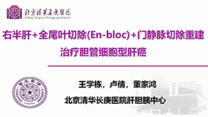 右半肝+全尾叶切除+门静脉切除重建（en-bloc）治疗胆管细胞型肝癌