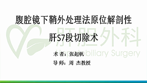 腹腔镜下原位解剖性肝S7段切除术（鞘外处理法）