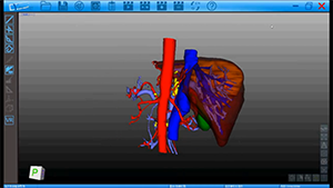 荧光显像引导下肝中叶巨大肿瘤切除术