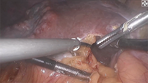 荧光腹腔镜下肝S4+S5、8段腹侧段切除术