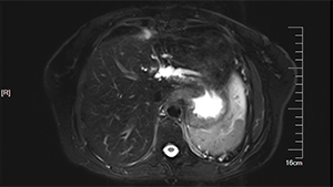 头背侧入路循中肝静脉左半肝切除术