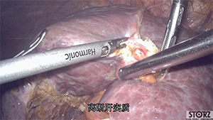 腹腔镜肝S4段+右前腹侧段切除术