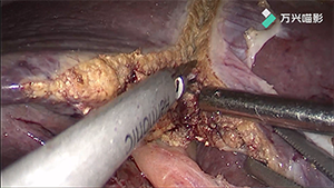 腹腔镜解剖性S4段肝切除