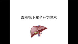 腹腔镜下左半肝切除术
