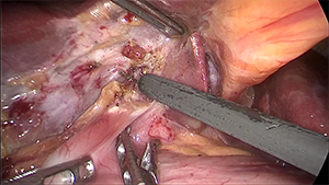 腹腔镜肝门部胆管癌根治术