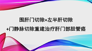 围肝门切除+左半肝切除+门静脉切除重建治疗肝门部胆管癌