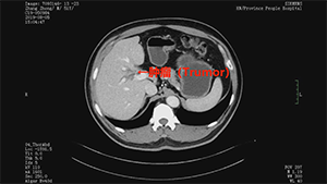 腹腔镜Ⅲb型肝门胆管癌根治术