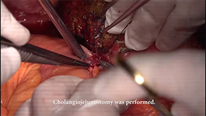 右三叶切除联合门静脉重建治疗肝门部胆管癌