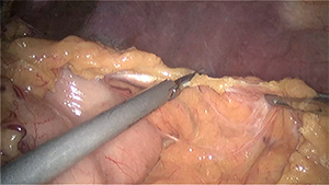 十二指肠乳头癌腹腔镜胰十二指肠切除术