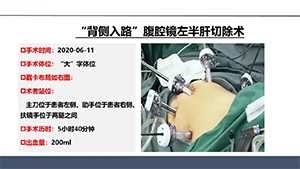“门静脉部分切除修补”的腹腔镜胰十二指肠切除术