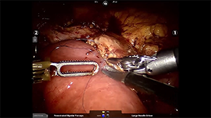 机器人辅助下胰十二指肠切除术