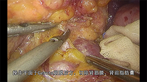 腹腔镜根治性顺行模块化胰脾切除术（RAMPS手术）