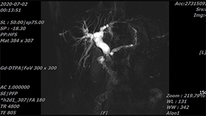 胰十二指肠切除联合肠系膜上静脉部分切除重建术