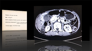 腹腔镜原位胰十二指肠切除（钩突切除）