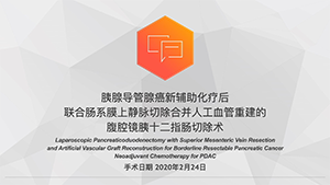 新辅助化疗后联合肠系膜上静脉切除合并人工血管重建的腹腔镜胰十二指肠切除