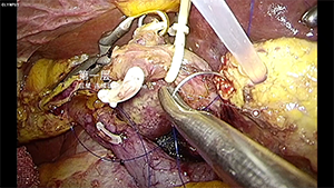 单孔腹腔镜胰十二指肠切除术