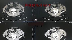 三步法动脉入路胰腺十二指肠切除术