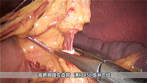 全腹腔镜远端胃癌根治术（Uncut Roux-en-Y吻合）