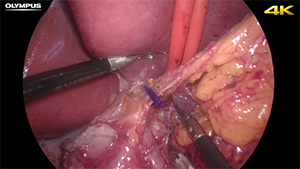 全腹腔镜根治性远端胃切除术+Roux-en-Y吻合