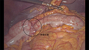头侧优先的混合入路右半结肠切除术