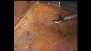 腹腔镜低位直肠癌前切除术