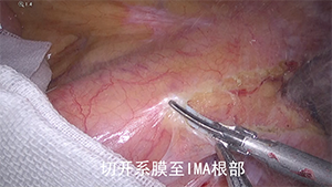 腹部无辅助切口经直肠拖出标本的腹腔镜乙状结肠癌根治术（NOSES）