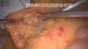 3D腹腔镜右半结肠切除术