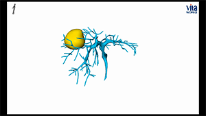 腹腔镜肝脏第七段切除术