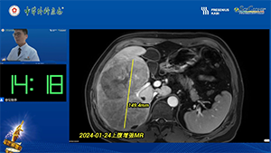 腹腔镜原位解剖性右半肝切除术治疗初始不可切除肝癌