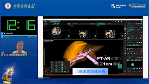 荧光腹腔镜S8v正染切除