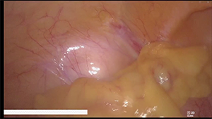 腹腔镜胃窦癌根治术