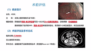 腹腔镜远端胃癌根治术