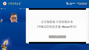 完全腹腔镜下远端胃癌根治术